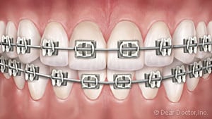 image of teeth with metal braces