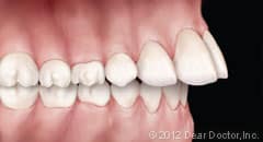 image of teeth protrusion