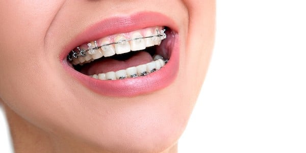 braces-