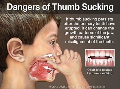 image of correcting teeth bad habits