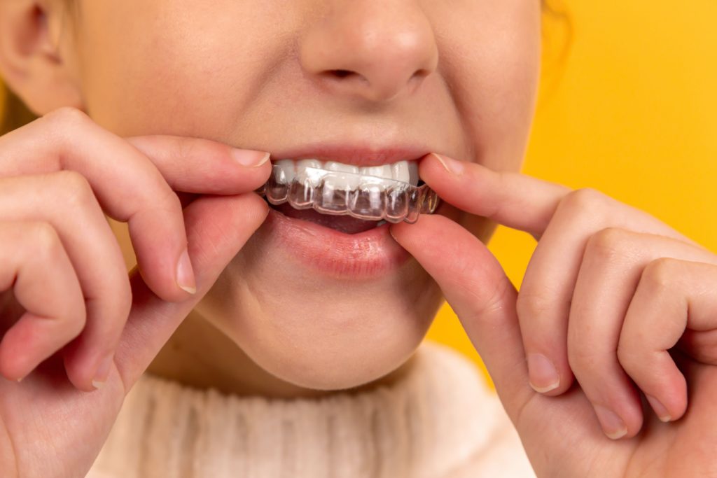 WhicSmile Direct Club vs orthodontist: Which should I choose for Invisalignh should I choose for Invisalign - an orthodontist or Smile Direct Club?