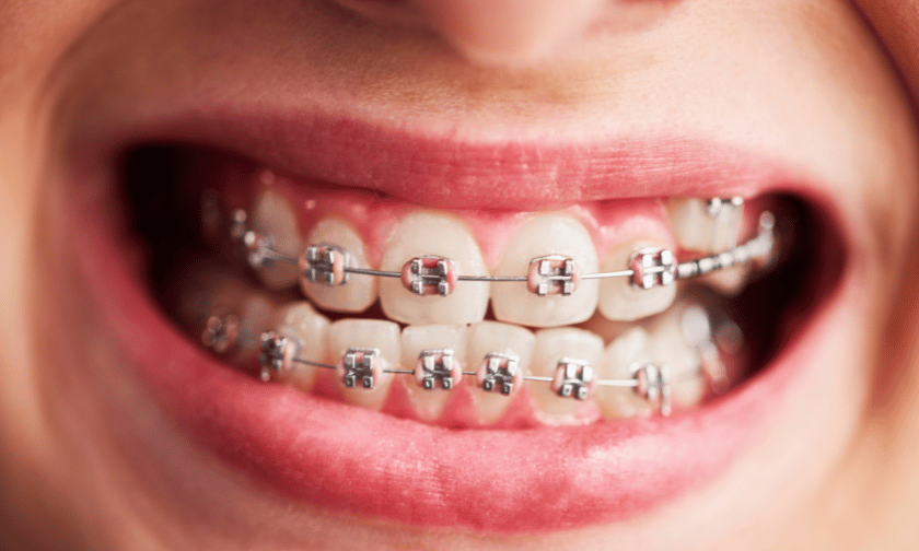 Learn about braces and its parts