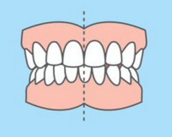 Unmatched dental midlines